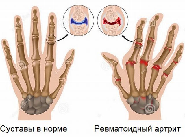 Симптомы артрита ревматоидного